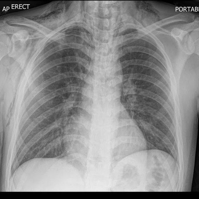 Boerhaave Syndrome
