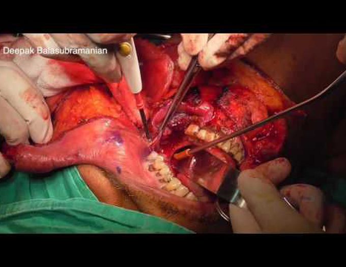 Segmental mandibulectomy