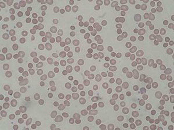 Hereditary Spherocytosis-Blood film