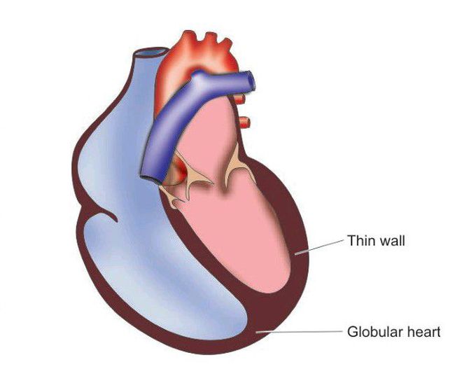 Wet (Cardiac) beriberi.