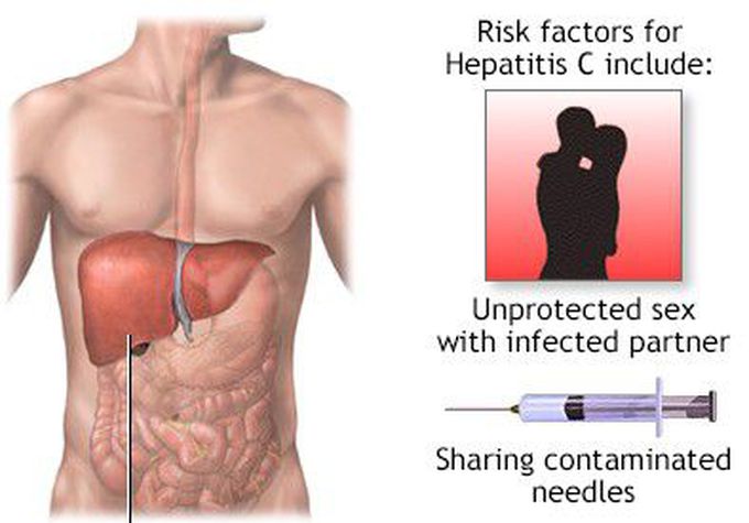 Hepatitis C