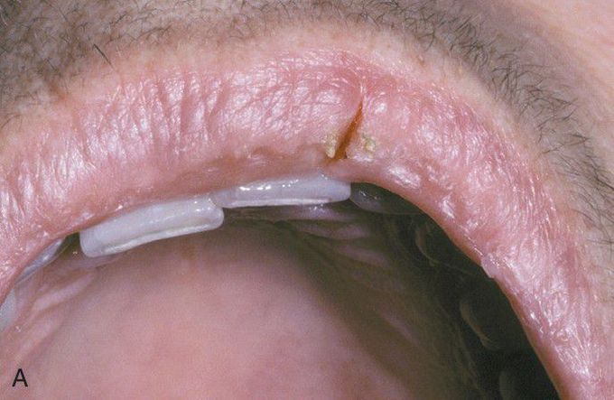 Lip Fissure.