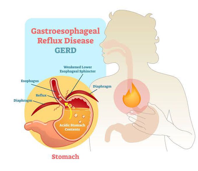 Cause of gerd