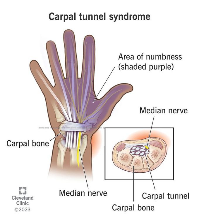 carpal tunnel syndrome treatment