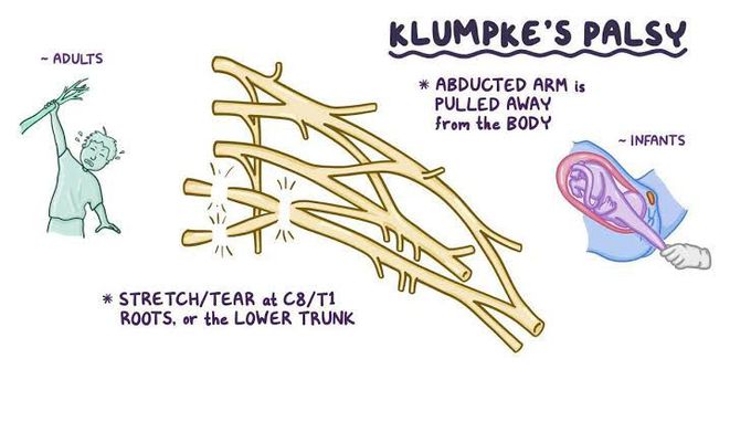 Klumpke's paralysis