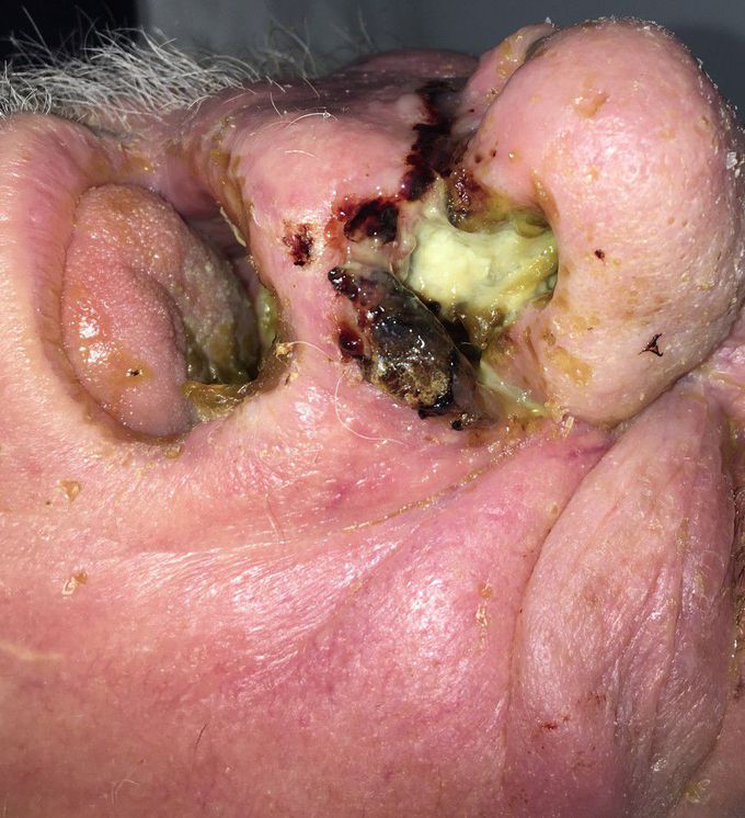 Nasal cancer
