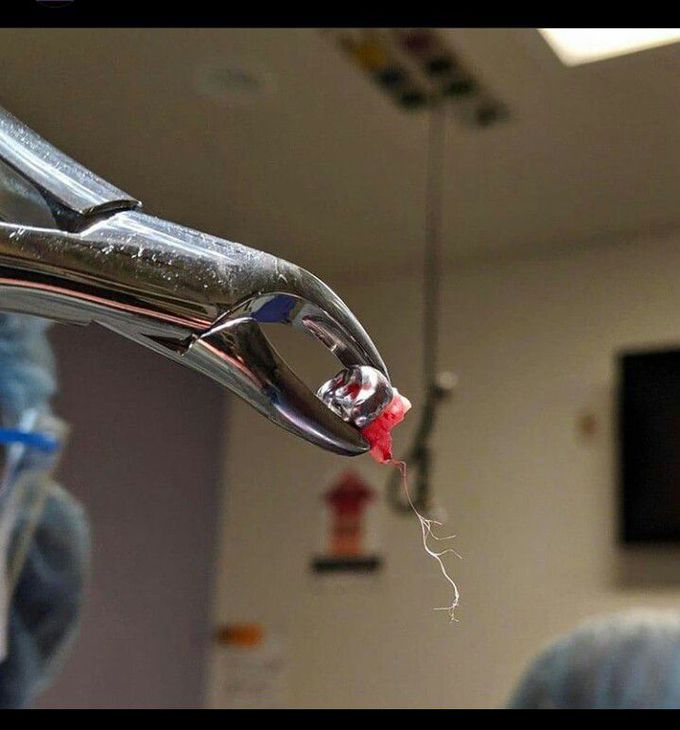 Extracted tooth with its nerve root