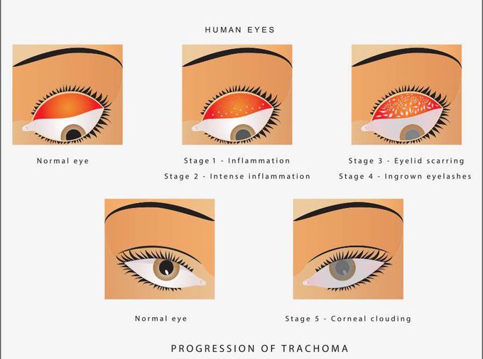 Trachoma