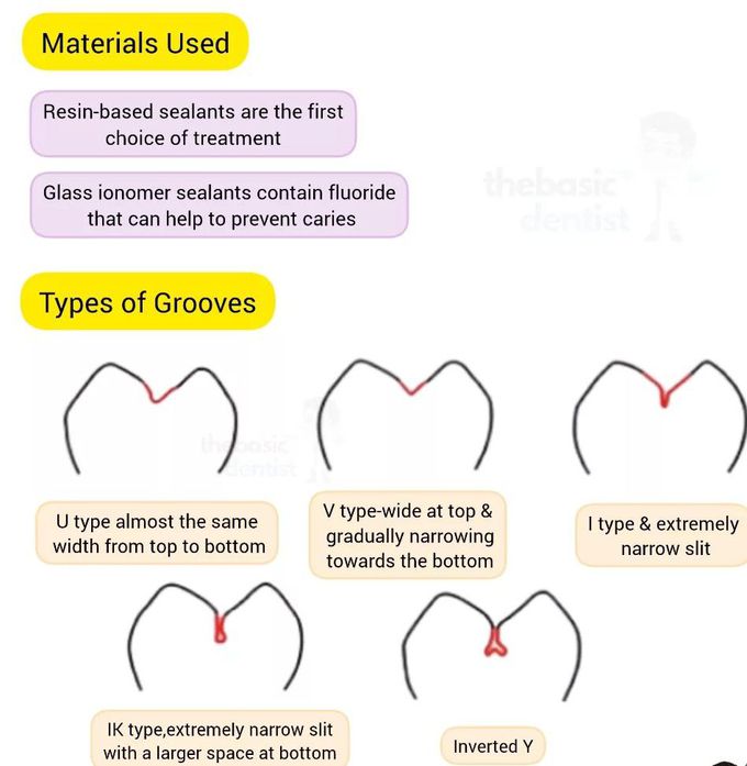 Pit and Fissure Sealants II