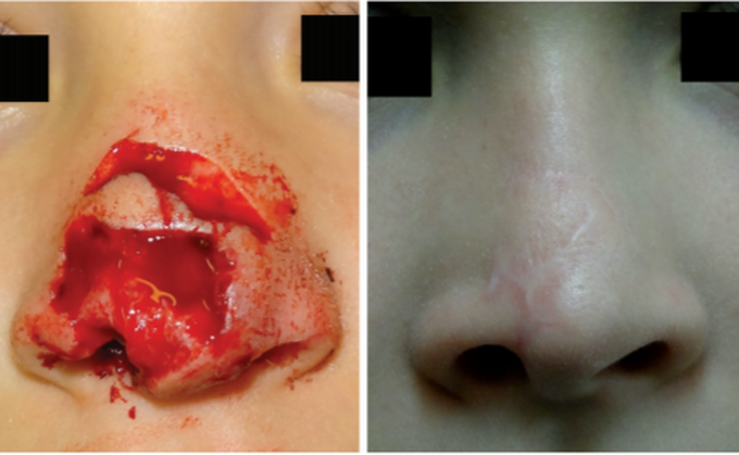 Dog Bite Avulsion Injury Management in Pediatric Age Group