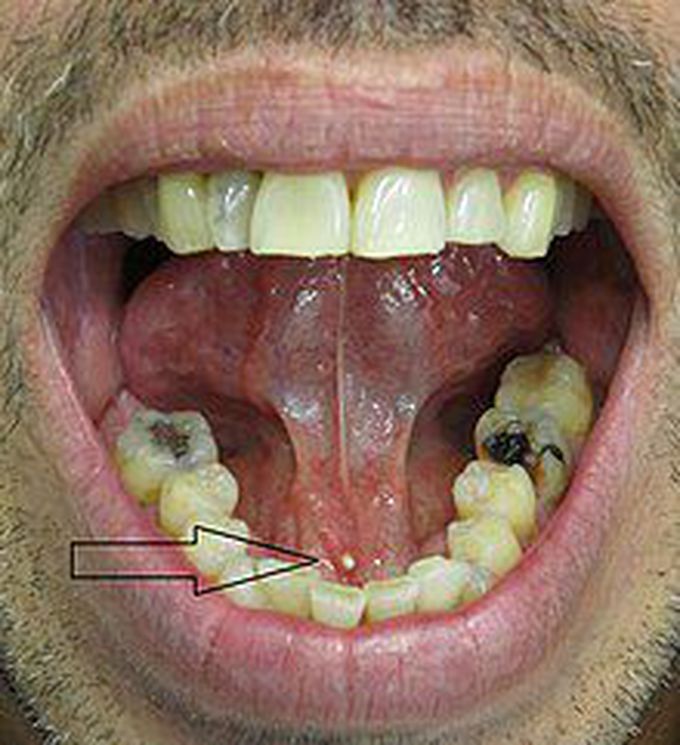 What are the symptoms of sialolithiasis?