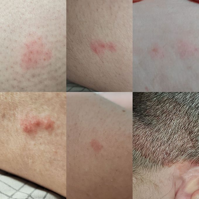 Undiagnosed rash