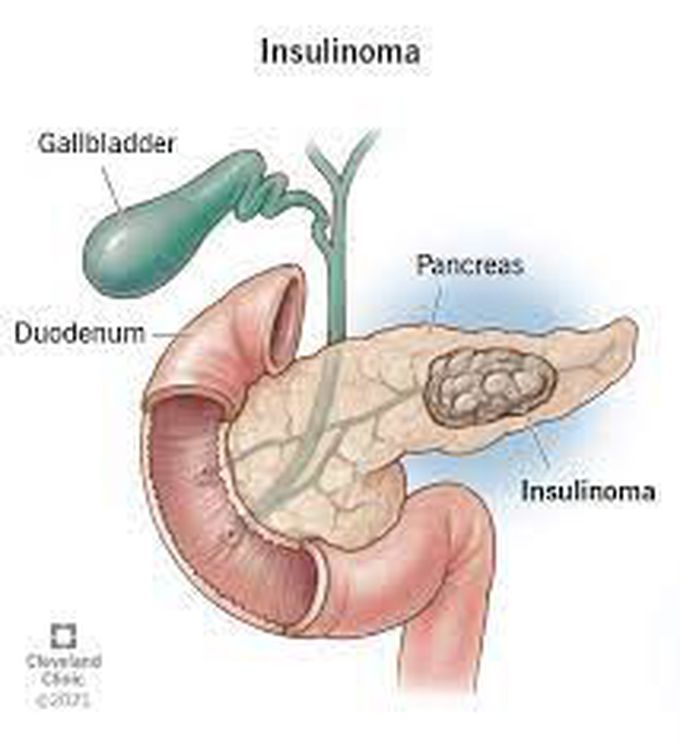 Insulinoma