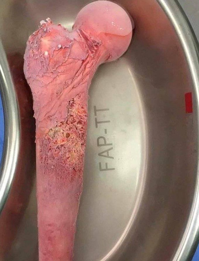 A Femur with Ewing Sarcoma