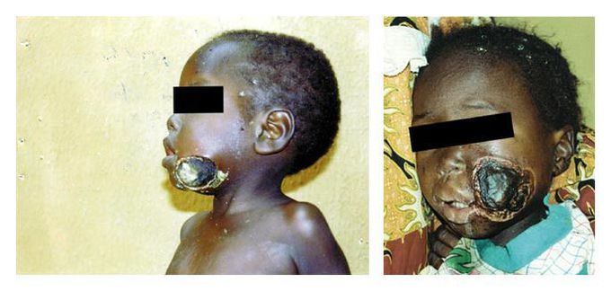 Noma: A Gangrene of Poverty