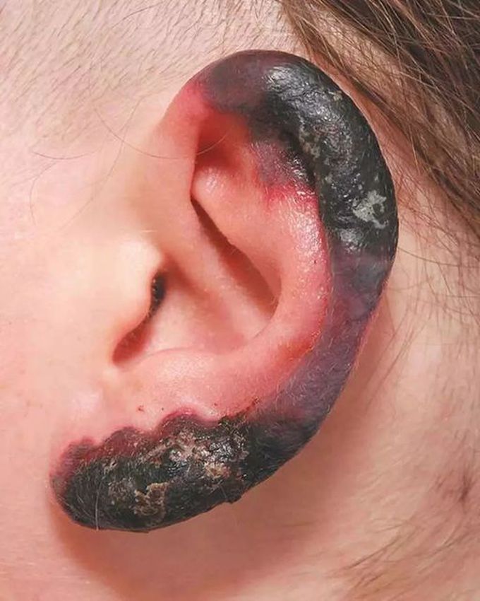 Cutaneous Necrosis on Ear