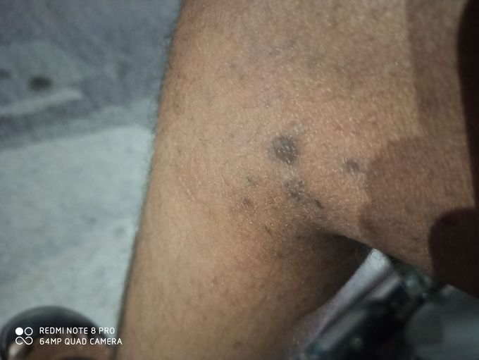 Skin disease