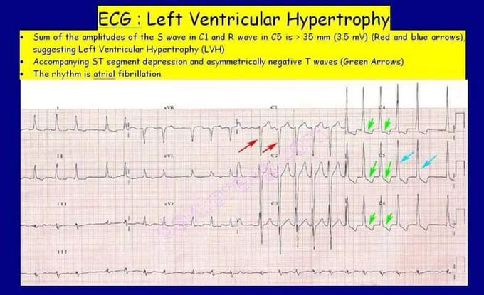 What Makes An Ecg Abnormal