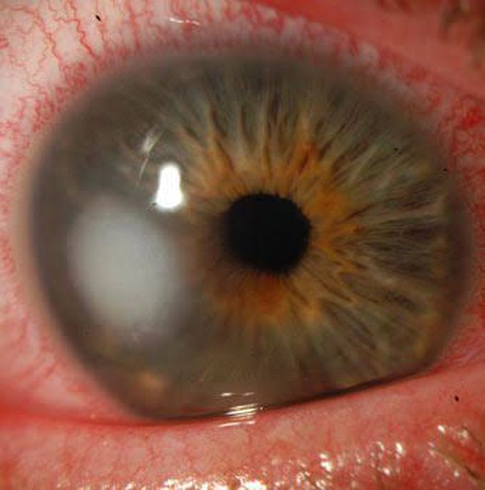 Corneal Ulcers