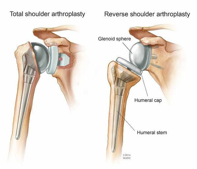 Shoulder replacement surgery