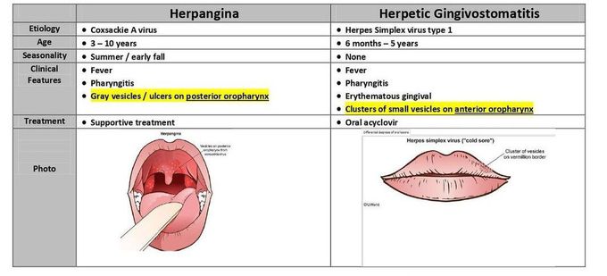 Herpangina Vs Herpetic Gingivostomatitis