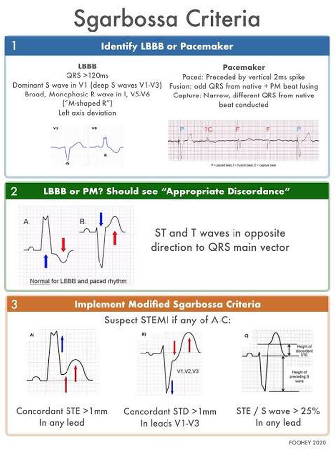 Sgarbossa Criteria