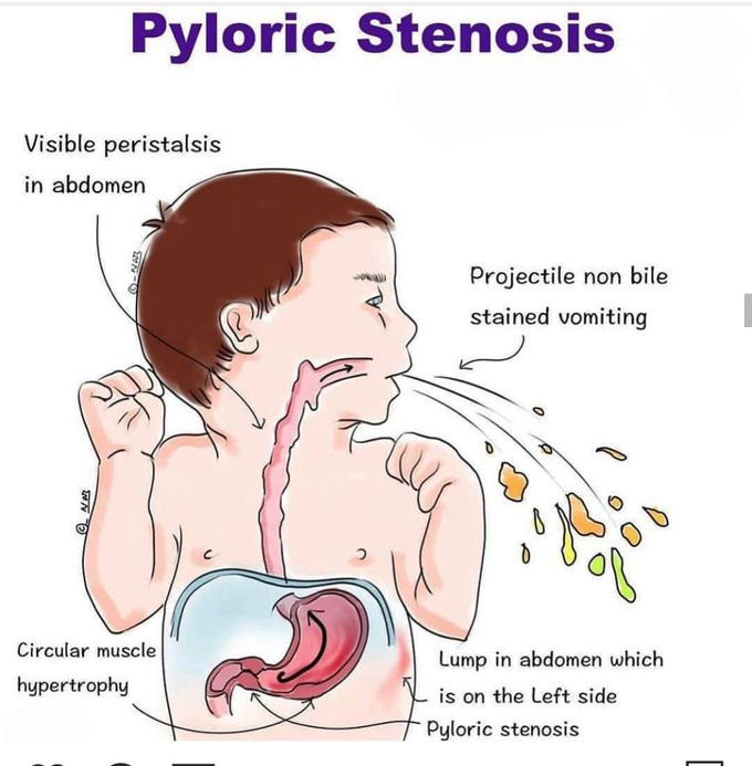 Pyloric stenosis