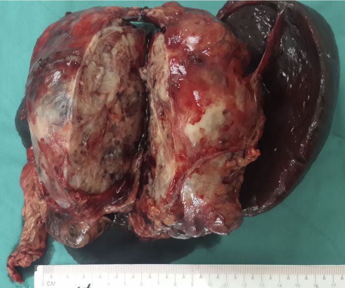 Whipple Triad of Insulinoma