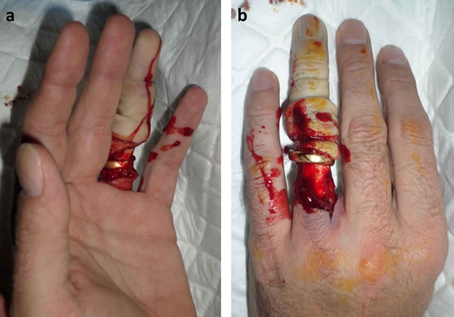 Ring Avulsion Injury