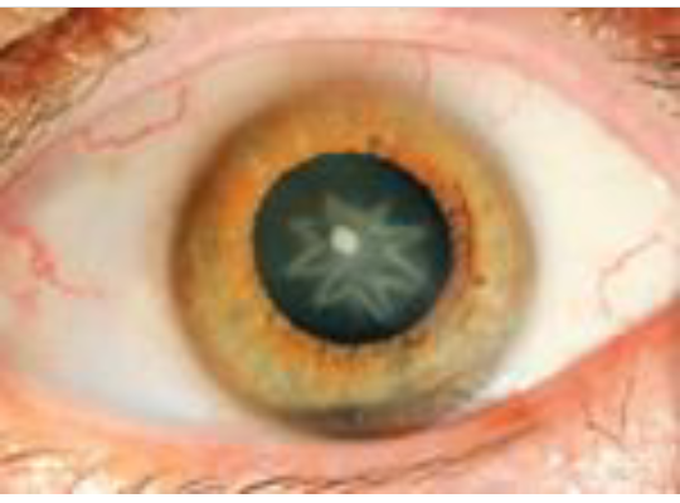 About eye