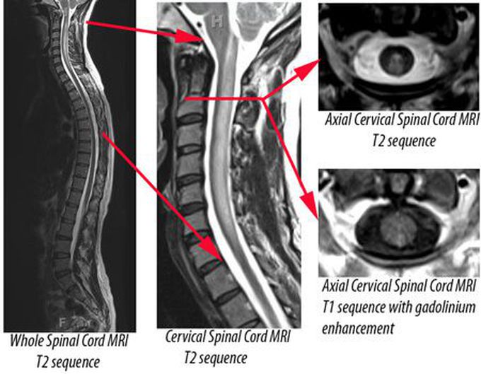 diagnosis of transverse myelitis