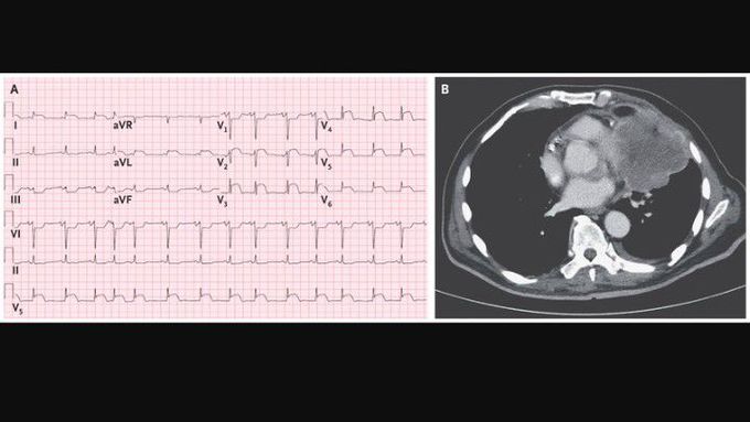 A STEMI Mimic