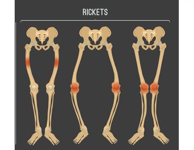 Rickets