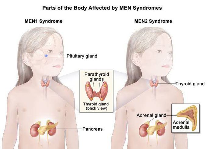 Parts of the body which are affected by MEN syndrome