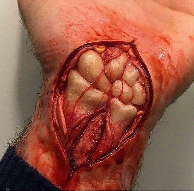 Accident after riding a bicycle