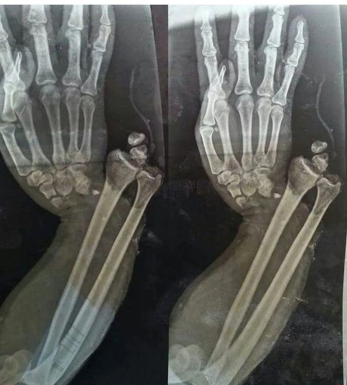 Open Fracture Dislocation of the Wrist