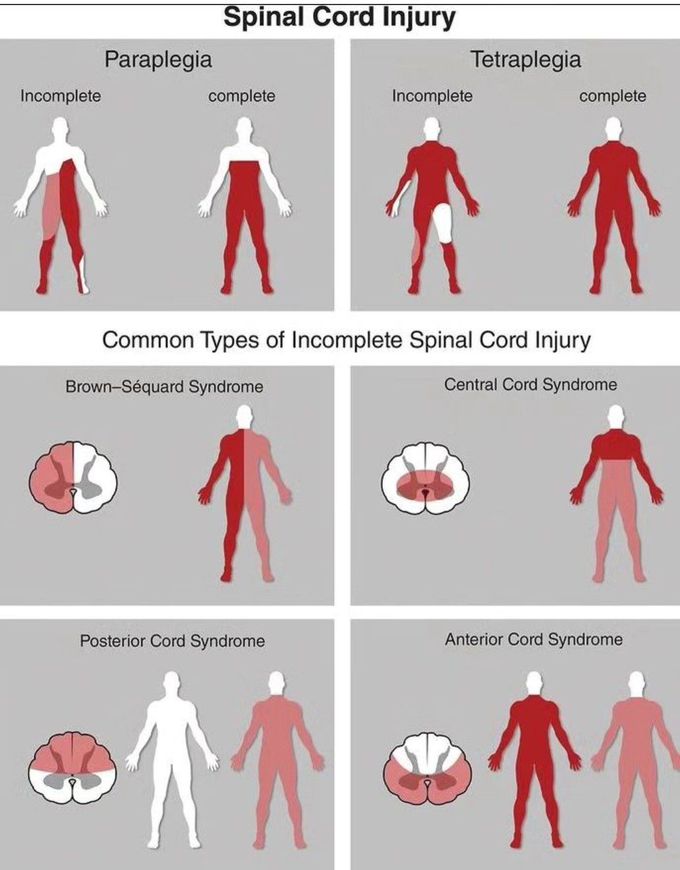 Spinal Cord Injury