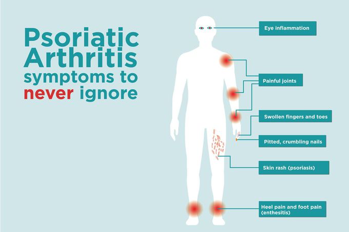 Symptoms of Psoriatic arthritis