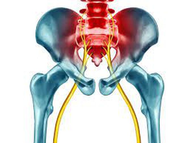 What is sciatica?