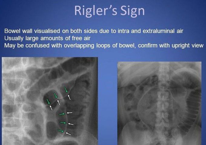 Rigler sign