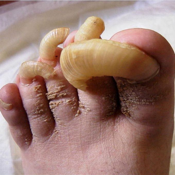 Onychogryphosis