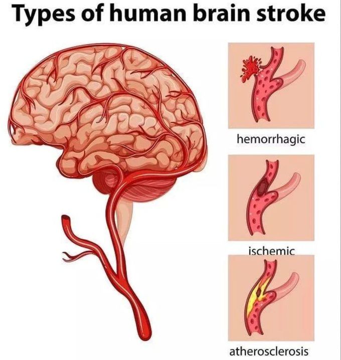 Brain Stroke- Types