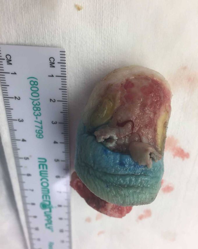 Amputation of the great toe for Melanoma