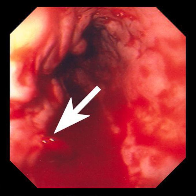 Esophageal Varices on Endoscopy