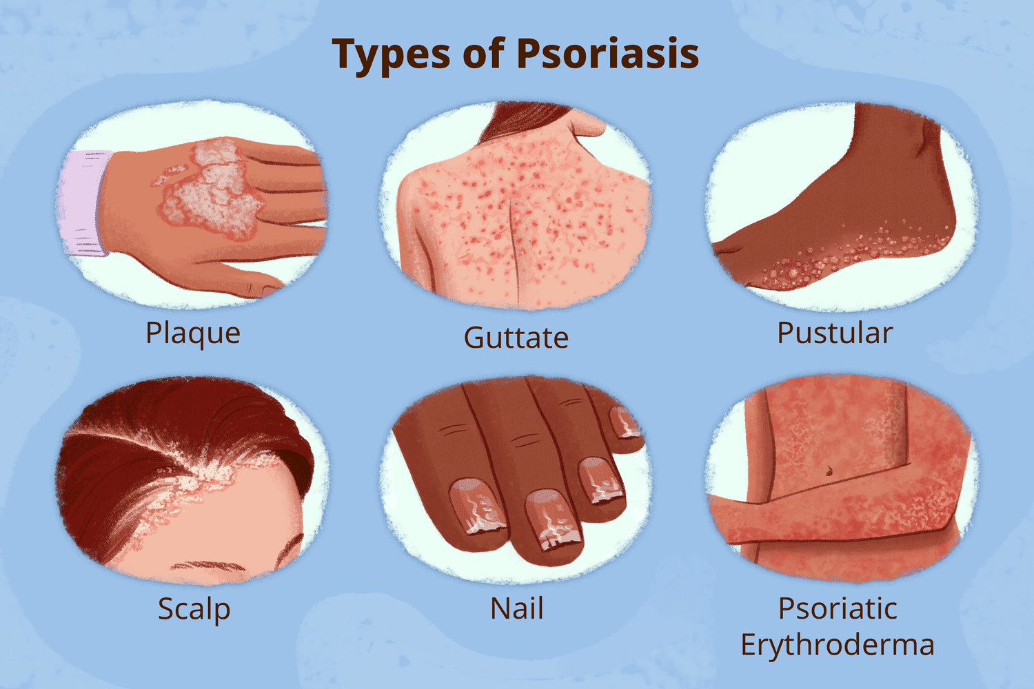 Why Psoriasis Comes And Goes