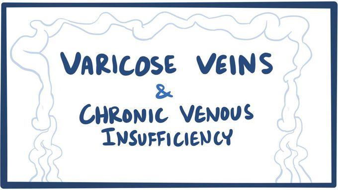 Varicose veins & chronic venous insufficiency (CVI)