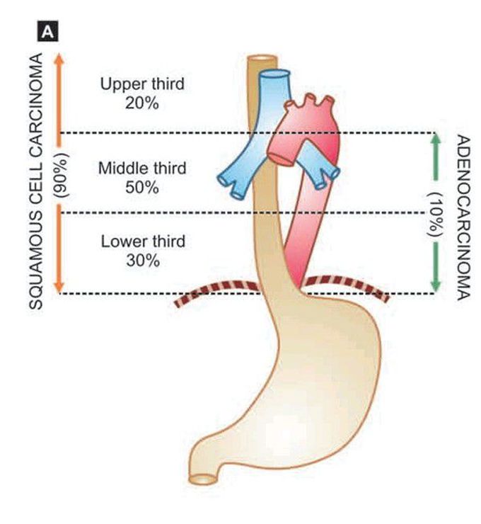 Carcinoma oesophagus