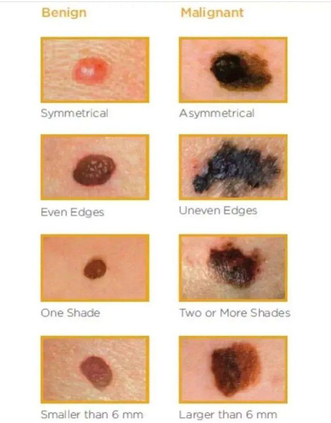 Benign Vs Malignant Lesions