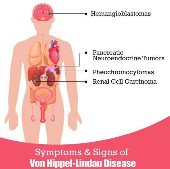 These are the signs and symptoms of Von Hippel Lindau syndrome
