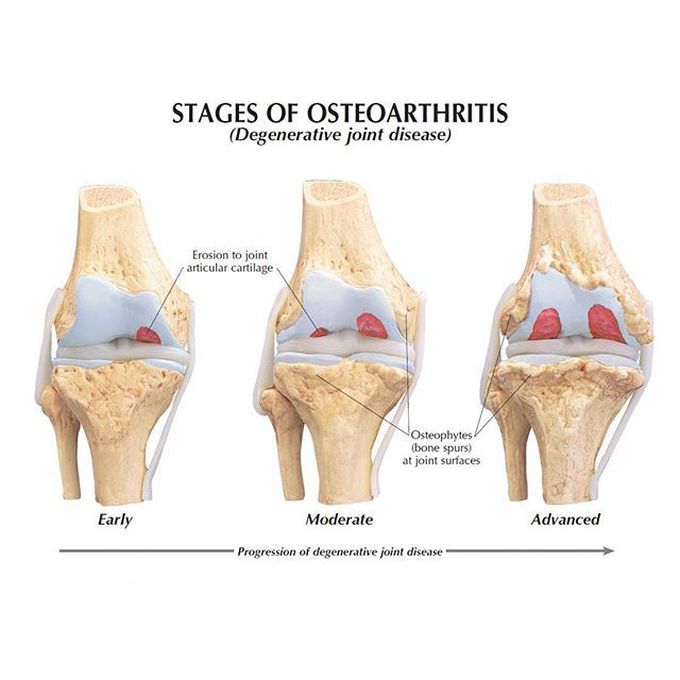 Knee Osteoarthritis